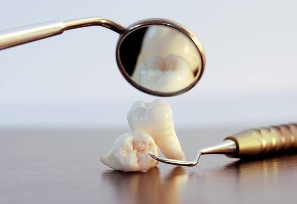 Чорніють пломби? Стоматологи Києва пояснили, що з цим робити